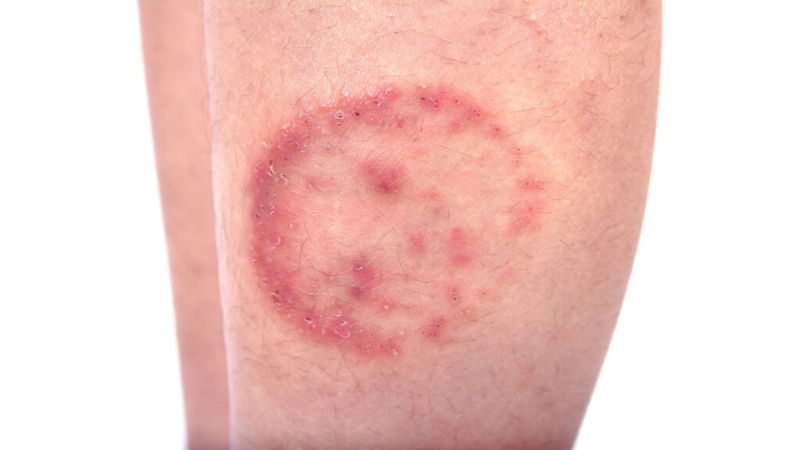 Get Proper Relief for Your Skin With Eczema Treatment in Houston, TX